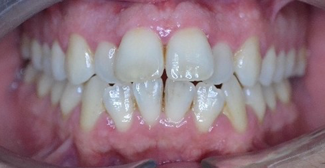 Before photo of Ortodoncia con Brackets – 24 meses