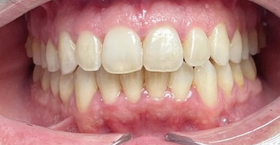 After photo of Ortodoncia con Brackets – 24 meses