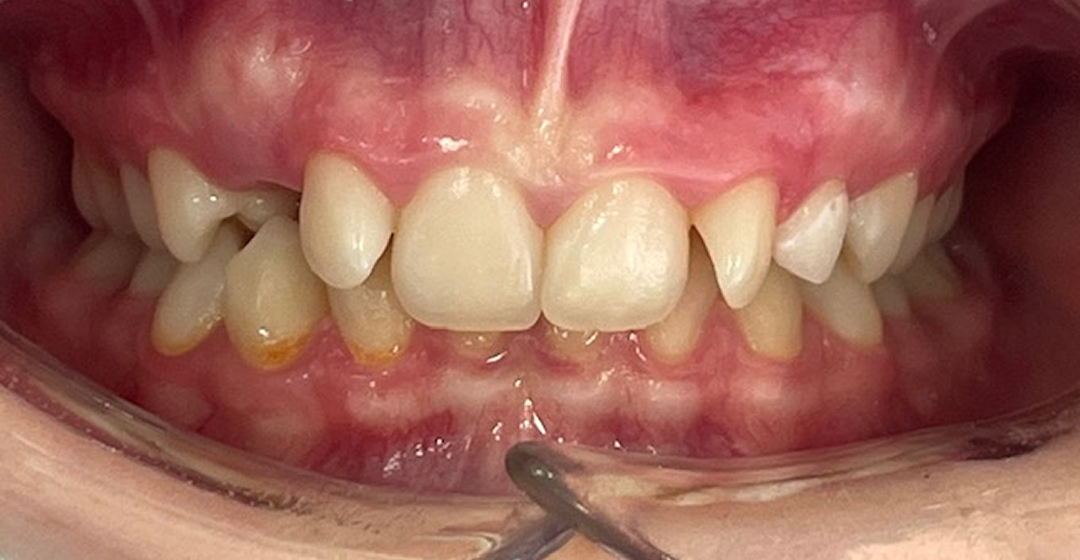 Before photo of Ortodoncia con Brackets – 18 meses