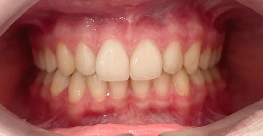 After photo of Ortodoncia con Brackets – 18 meses