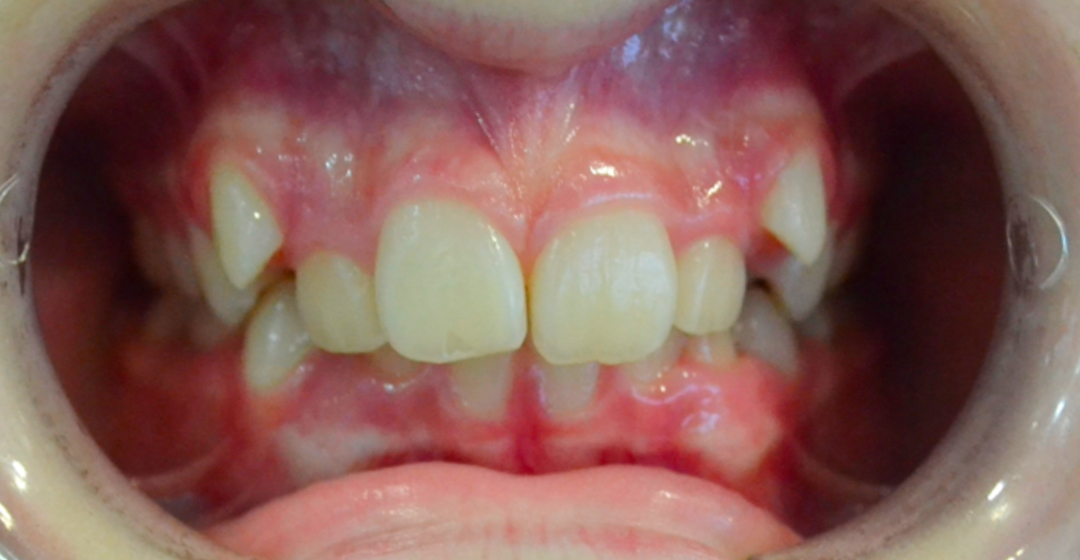 Before photo of Ortodoncia con Brackets – 20 meses