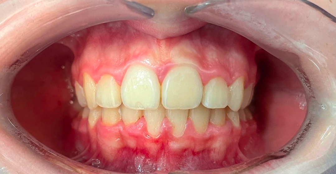 After photo of Ortodoncia con Brackets – 20 meses