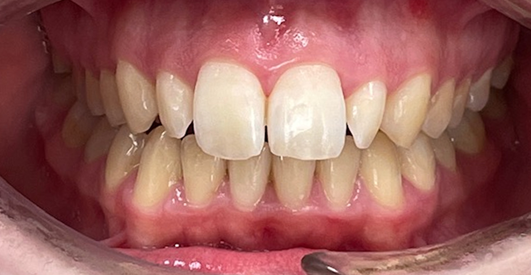 Before photo of Invisalign & Carillas – 18 meses