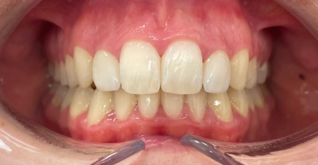 After photo of Invisalign & Carillas – 18 meses